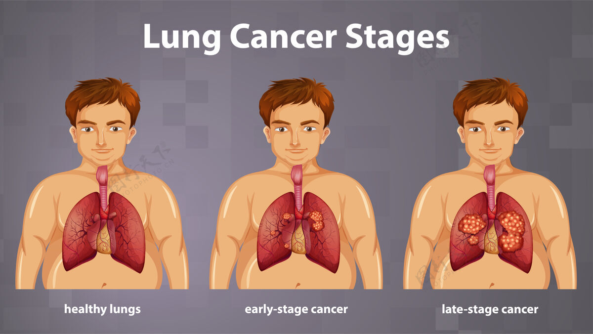 身体肺癌分期的资料性说明科学学习医学
